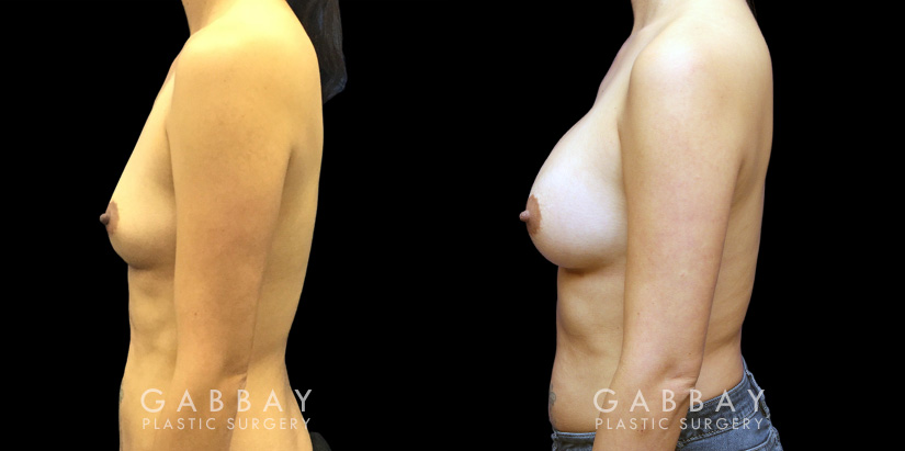 Breast augmentation results for patient in her 40s. Volume increase is mild but retains a natural shape to the breasts with retained symmetry.