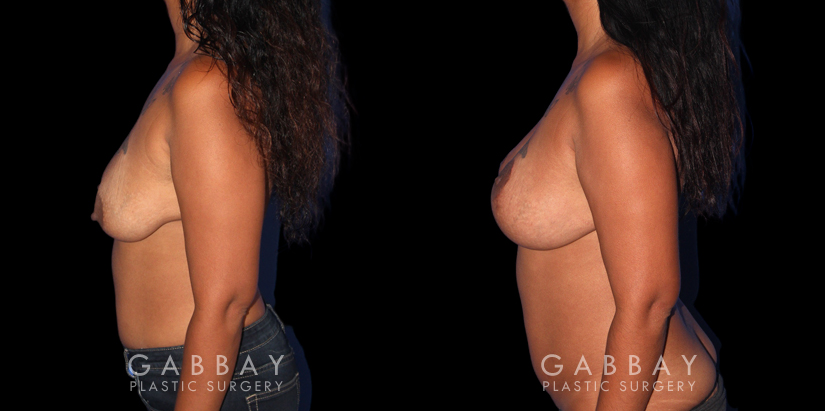 Patient 25 Left Side View Wise Mastopexy with Silicone Breast Implants Gabbay Plastic Surgery