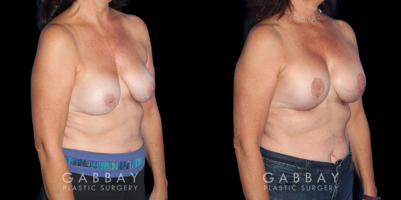 Patient 26 3/4th Right Side View R&R Breast Lift Gabbay Plastic Surgery