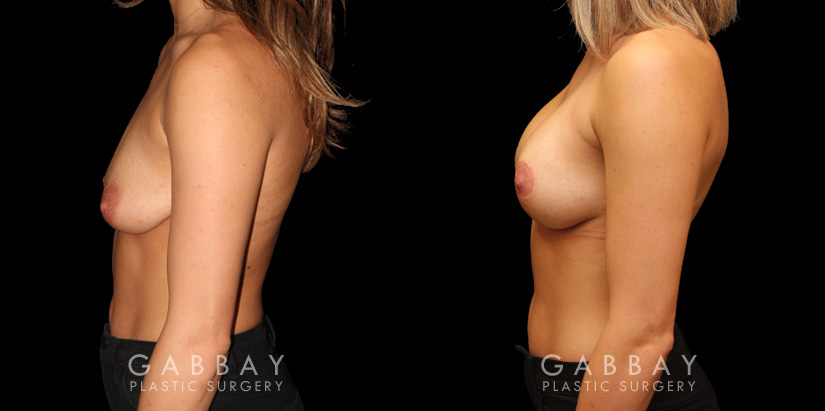 Mastopexy with Breast Augmentation