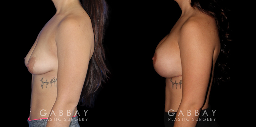 Breast Augmentation w/ Mastopexy – Silicone