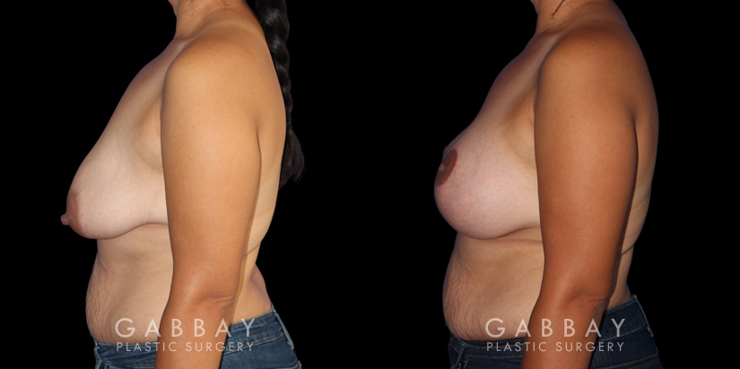 Breast Augmentation – Silicone, Mastopexy