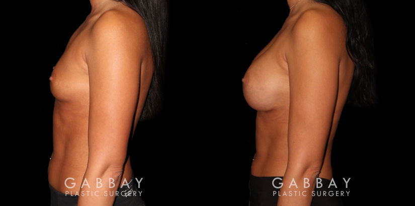 Patient results for breast augmentation. Note the rounded shape and lack of visible scarring. Patient’s recovery was smooth, absent of complications.