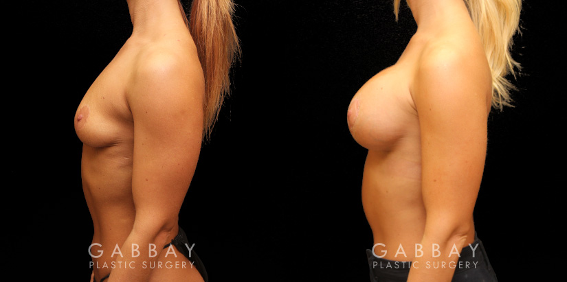 Patient 08 Left Side View Implants repeal & replacement (left) Gabbay Plastic Surgery
