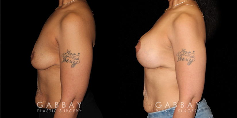 Breast Augmentation – Silicone & Lift