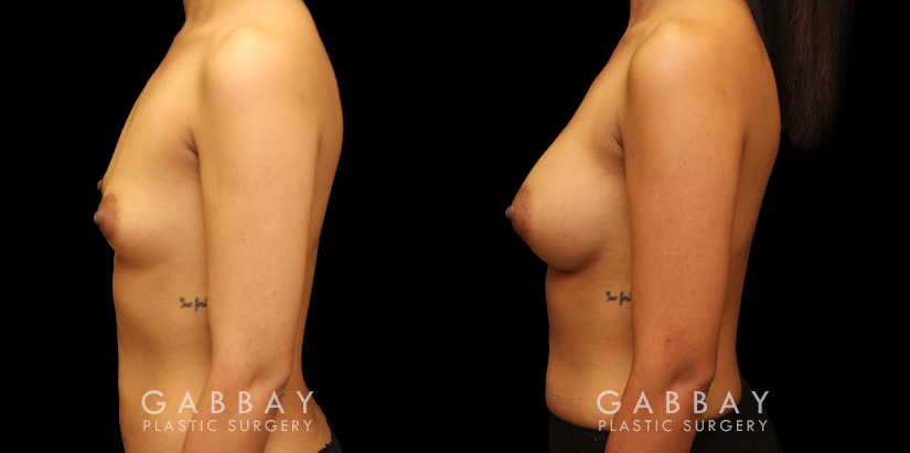 Before and after silicone implants for female patient. Her breast augmentation went smoothly and the recovery was without complications.