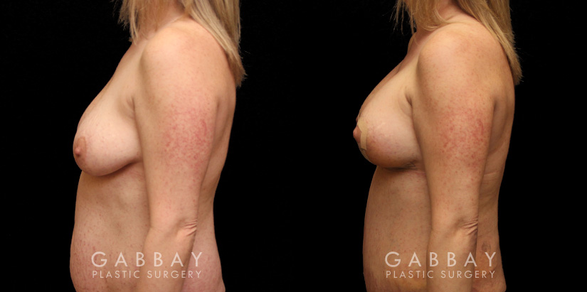 Patient 20 Left Side View Breast aug/pexy and tummy tuck Gabbay Plastic Surgery