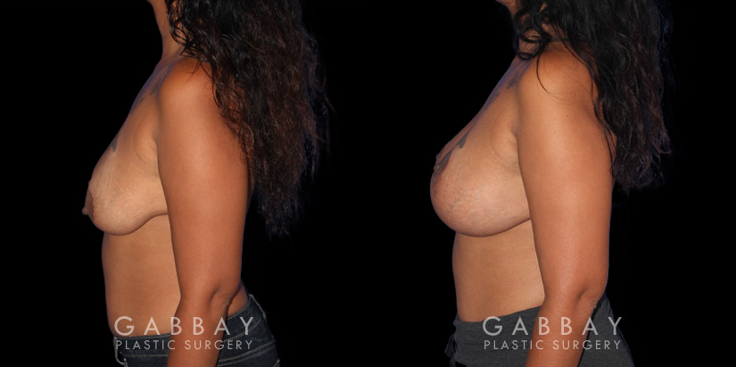Patient 21 Left Side View Wise Mastopexy with Silicone Breast Implants Gabbay Plastic Surgery
