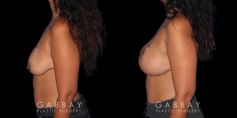 Wise Mastopexy with Silicone Breast Implants