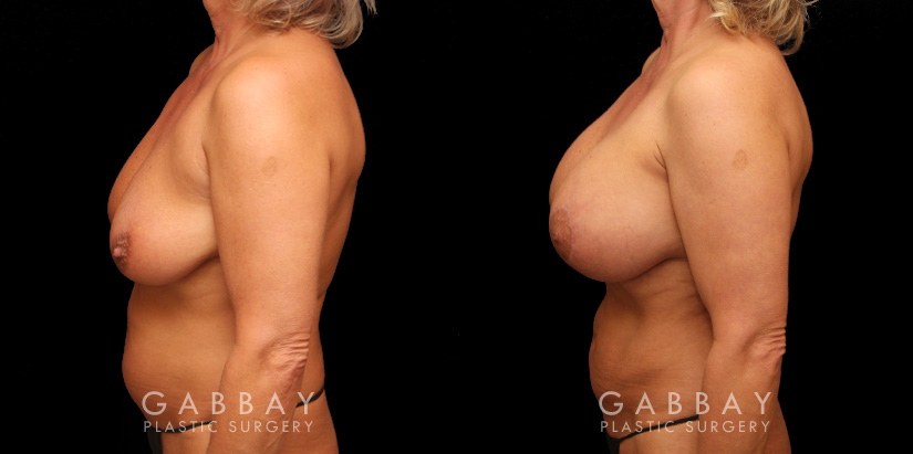 Breast Aug/Pexy with Liposcution and J-plasma to the Full Abdomen and Upper Back Bra Roll