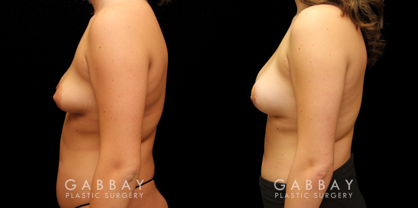 Patient 11 Left Side View Augpexy Gabbay Plastic Surgery