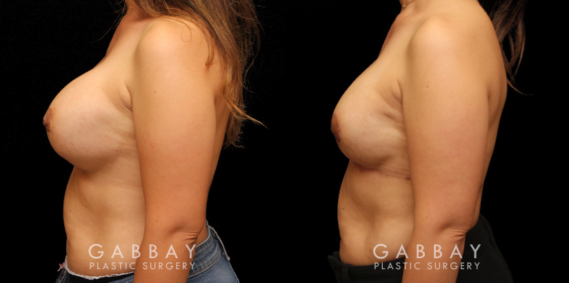 Patient 12 Left Side View Augpexy Gabbay Plastic Surgery