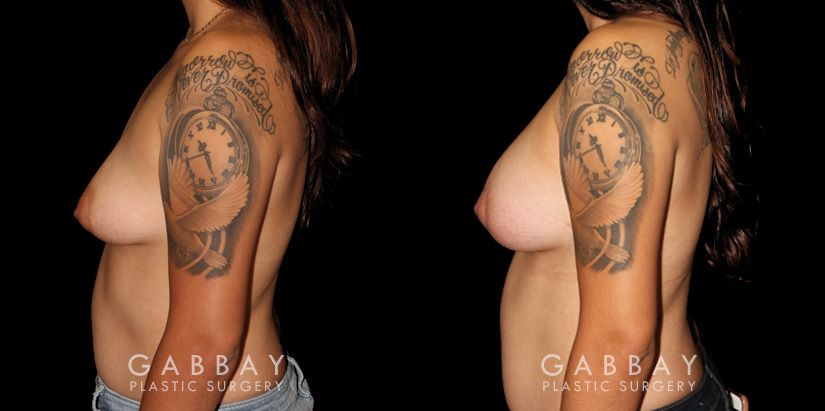 Patient 13 Left Side View Augpexy Gabbay Plastic Surgery