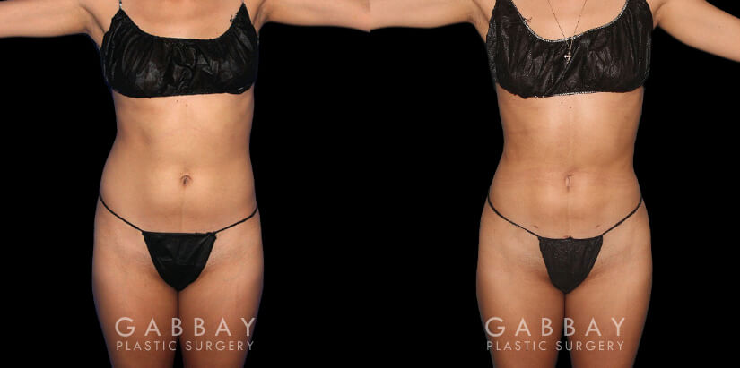 Multiple angle view of Caucasian patient in her mid-30s before and after mini Brazilian butt lift surgery and combined 360 liposuction for body contouring and butt augmentation. Liposuction provided improved abdominal contouring focusing on the abdomen, waist, and tailbone areas. The transferred fat settled well into round-shaped buttocks for a stable cosmetic enhancement as part of this skinny BBL.