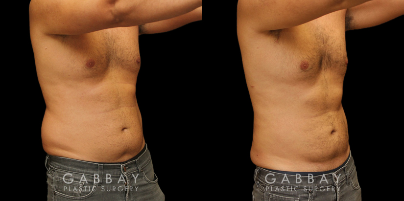 Late 30s male patient before and after male liposuction. Targeted fat removal resulted in a flatter abdomen and significant reduction of flank volume. Note the reduction of waist curves for a straighter silhouette.