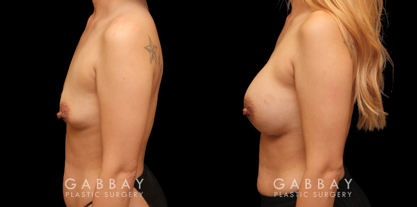 Breast augmentation results after complete recovery. Careful placement of silicone implants resulted in natural breast appearance and position.