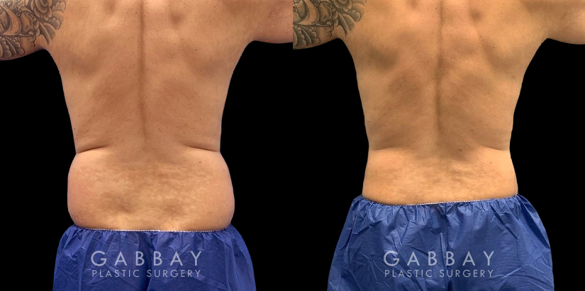 Male liposuction before-and-after photo for 360 lipo showing a result in a slimmer waist and flatter abdominal area for an enhanced torso contour. Flanks are significantly slimmed and present a toned silhouette.