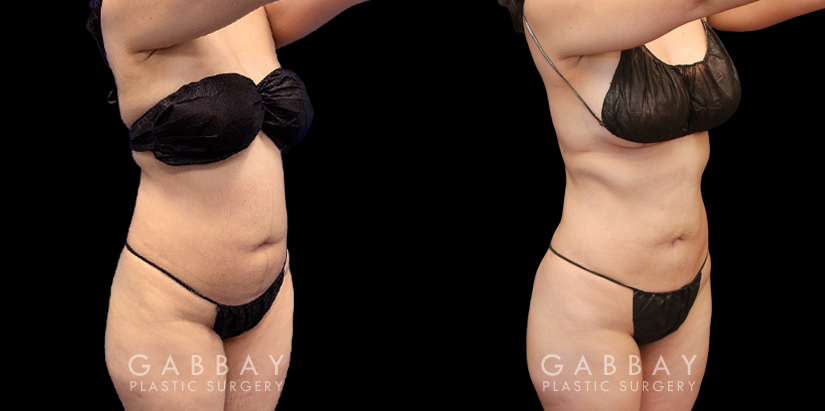 Before and after surgical liposuction for the abdomen, removing stubborn fat with minimal use of invasive techniques. Note the visible belly fat reduction for a smoother contour.