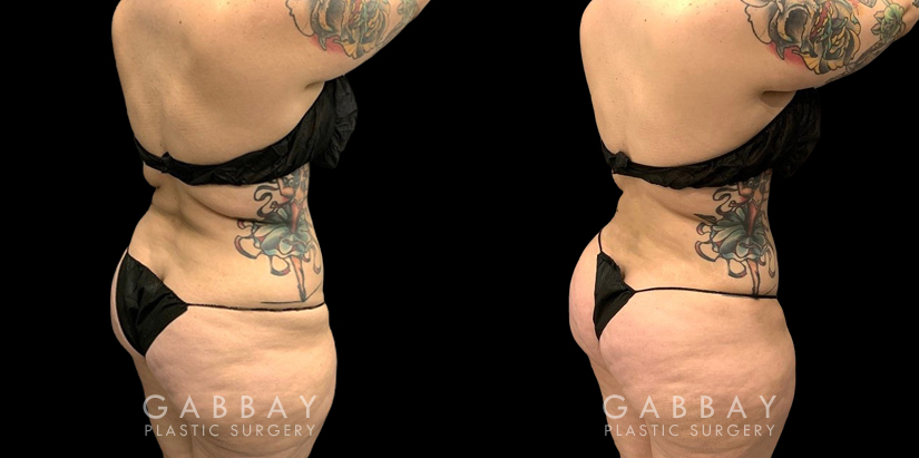 Female liposuction results for a flatter abdomen. Note how fat reduction was done with her natural figure in mind for results that match her unique features.