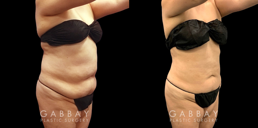 Mid 40s female patient after abdominal liposuction results have full healed, showing a tightened lower torso with belly rolls smoothed out for a flatter overall contour.