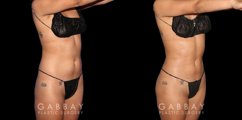 Before-and-after for patient with combined cosmetic surgeries, including BBL, abdominal lipo. Note the 360-degree slimming with enhanced buttocks roundness from the natural fat transfer.