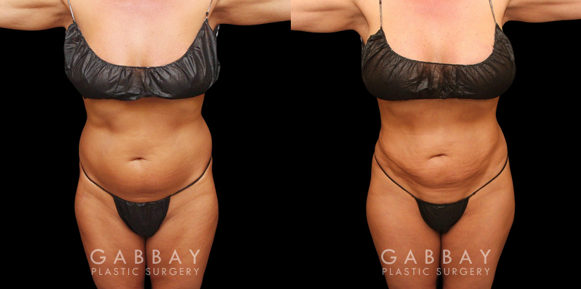 Female African-American patient after liposuction and J plasma treatment to her full abdomen, reducing her bulging belly and to tighten and restore loose skin.