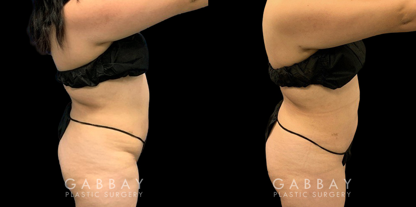Patient who wanted mild liposuction to reduce tummy bulge from stubborn fat, with subtle results that lend a more balanced figure. Note how the puncture sites healed well for little to no visibility.