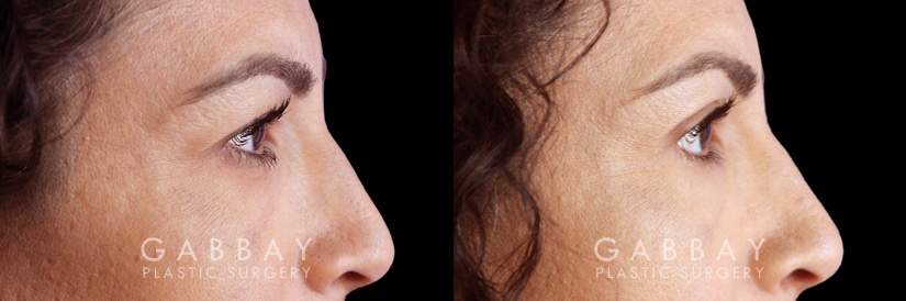 Patient 01 Right Side View Blepharoplasty Gabbay Plastic Surgery