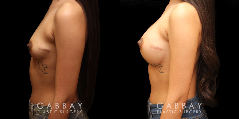 Breast augmentation for younger female patient. Note the pleasing roundness to the breasts that matches her natural body shape well for an attractive enhancement.