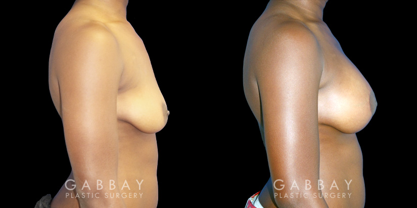 Silicone breast augmentation before-and-after photos demonstration enhanced breast size. Patient combined augmentation with a breast lift for improved breast position as well.