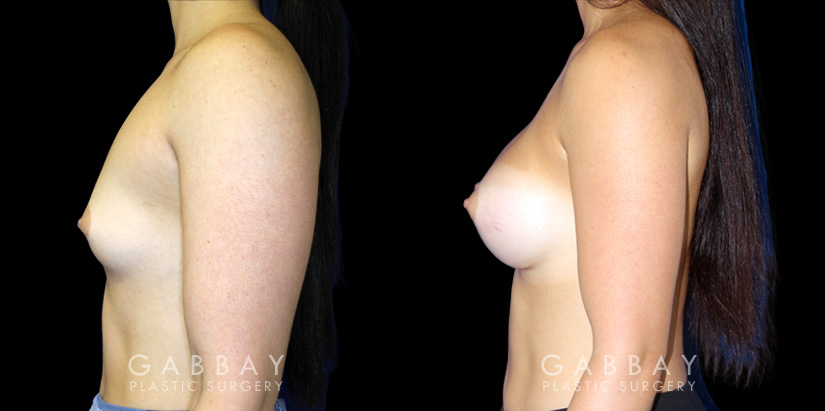 Patient with silicone implants, photos demonstrating final breast size after complete and uncomplicated recovery period. Note the improved profile and side angles, with no visible scarring.