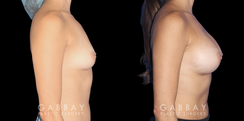 Breast augmentation before-and-after photos for female patient. Final results healed well, matching her body shape and contour well.