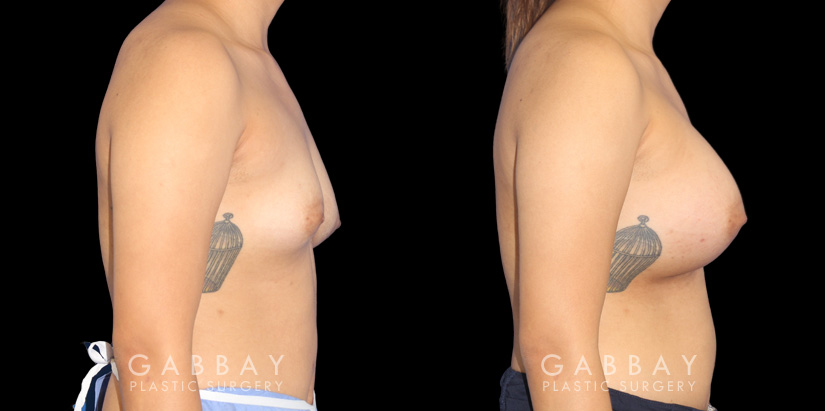 Silicone breast augmentation results, with patient having notable increase in breast volume and protrusion. But the breasts still maintain a balance between them.