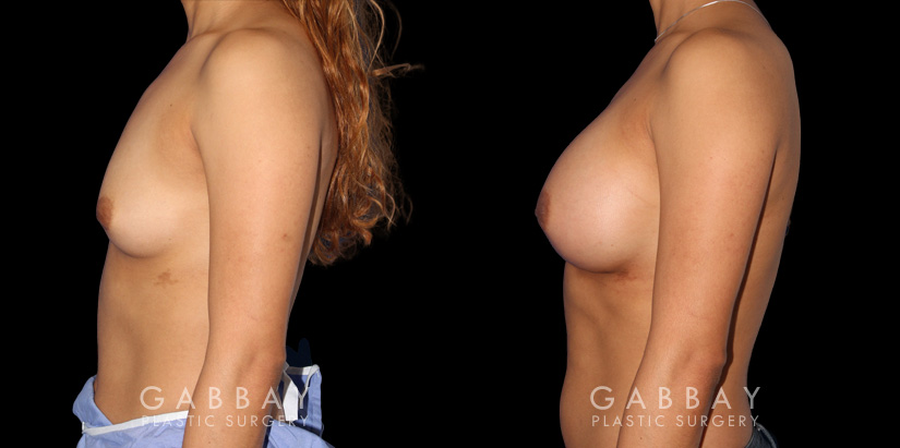 Silicone implant results for female patient in her 30s. Mild increase to volume allowed for balanced results that match her natural body contours.
