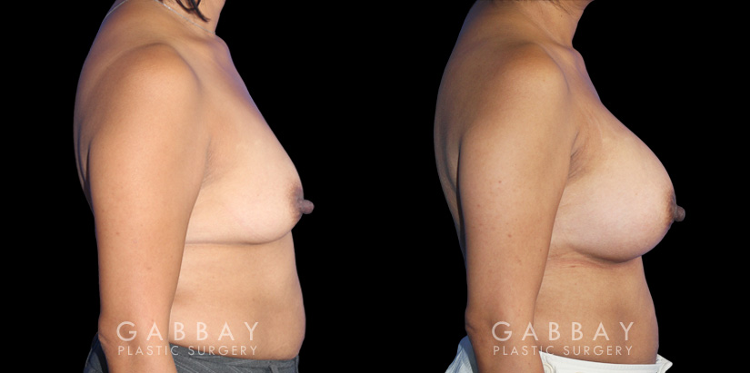 Patient before and after silicone implants with complete, uncomplicated recovery. Volume increase is notable while also improving the balance between breasts without resorting to unnatural perfect symmetry.