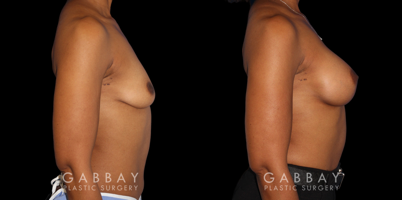 Before-and-after photos for saline implant breast augmentation patient. Her implant choice allowed for more natural shape and slope to the breasts, most notable in the profile view.