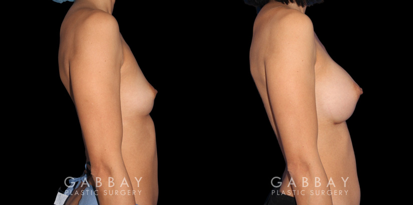 Patient result photos following silicone implant breast augmentation. Patient elected for a rounder shape with mild breast protrusion for subtle yet alluring results.