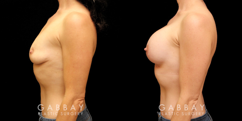 Patient with combined areola lift and breast augmentation, photos showing her before and after the procedure. Not the improved breast position and increased volume.