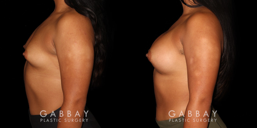 This is a young woman with a tuberous or constricted breast deformity. The lower portion of the breast developed more tightly than the rest of the breast. She wanted a more full, but natural breast appearance. She had silicone breast augmentation, with placement of an Allergan naturelle soft touch silicone breast implant through a lower breast/inframammary fold incision. Her moderate profile implants were 310 cc. Patients like this are prone to lower breast complications such as a double bubble, but with careful performance of the operation, she easily avoided this complication.