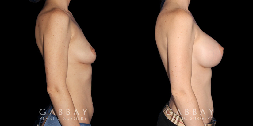 Saline breast augmentation results. Note how the breasts increased several cup sizes in volume while still balancing with the patient's natural body shape. Breast slope is mild with impression protrusion in the silhouette.