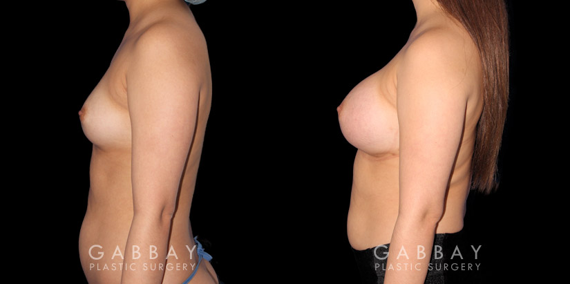 Silicone breast implants after full recovery. Patient increased breasts by several cup sizes without stretching out the skin, maintaining a round alluring shape with boosted volume.