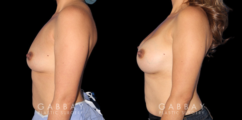 Silicone implants used to increase breast volume while keeping a natural shape. Patient healed well with no complications.