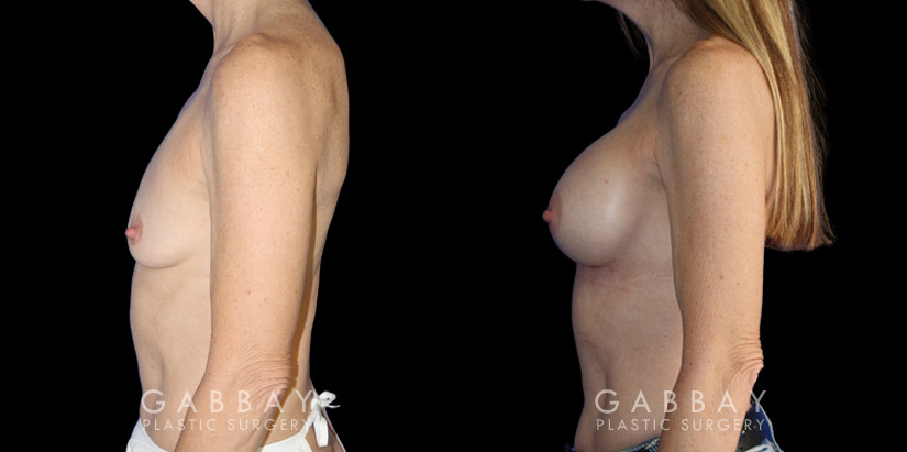 Female patient in her late 40s with breast augmentation results using silicone implants. Patient healed well and achieved a breast size and appearance that enhances a youthful contour and appearance.