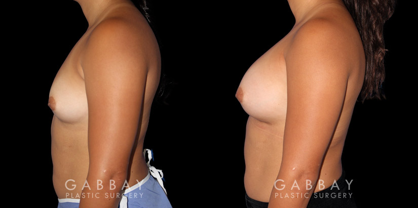 Breast Augmentation before-and-after photos demonstrating increased breast volume using silicone implants. Patient sought a milder increase to bust while keeping the volume within a natural range.