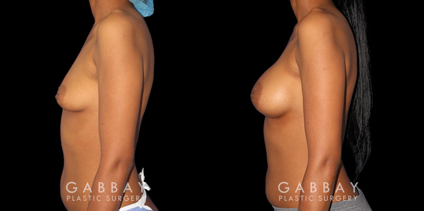 Silicone implants were used to increase breast volume while preserving the patient’s natural breast shape. The increased bust size resulted in a feminine, refined profile.