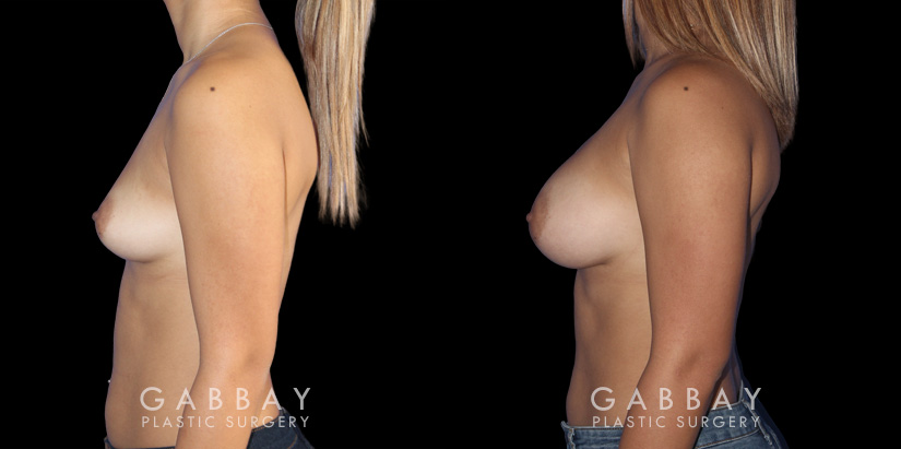 Visual of results following recovery for breast augmentation with saline implants. Patient shows dramatic increase in breast volume while keeping a more natural slope and shape to the breasts.