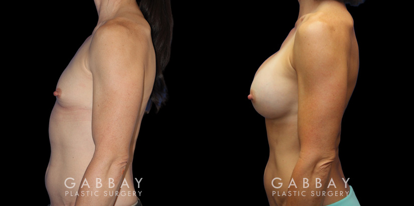 Breast augmentation results for patient with slim and fit body type. The silicone implants were chosen to match this tighter physique for a natural balance.