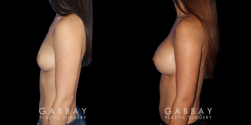Before-and-after photos for breast augmentation showing fully recovered patient. Note the lack of visible scarring despite the dramatic increase to bust volume. Balanced, round breast shape enhances the patient’s natural figure.
