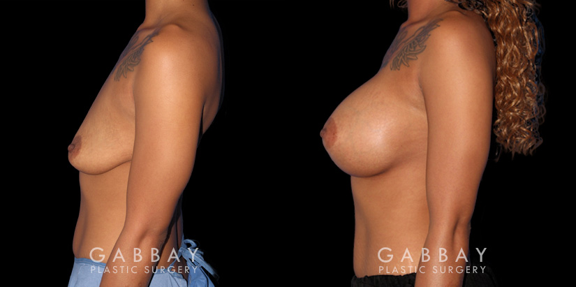 Patient breast augmentation results. The patient’s excess breast skin allowed for significant breast volume increase, most notable in the profile view.