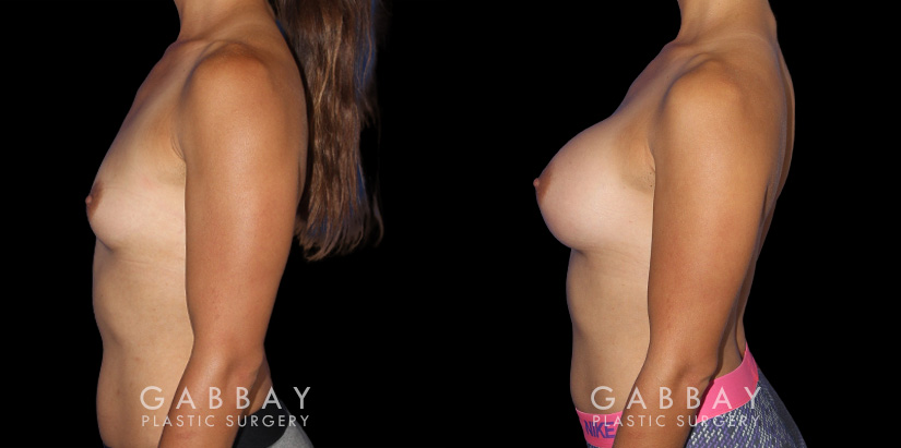 Patient recovered without complication and maintained a round, pleasing shape to her breasts. Scarring is hidden in the breasts natural folds, displaying only her positive results.
